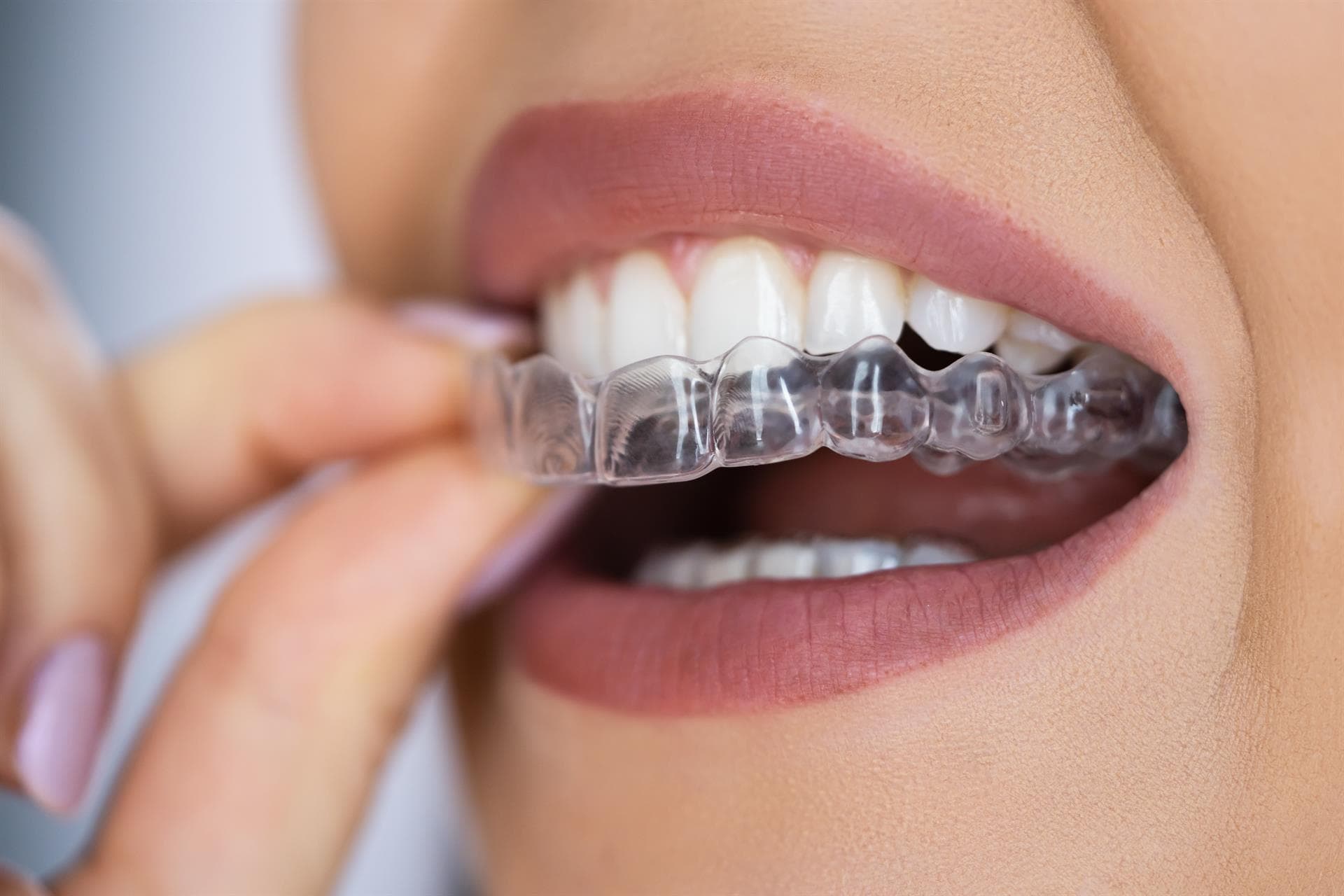 Invisalign: Crafting a Customised Path to Dental Harmony